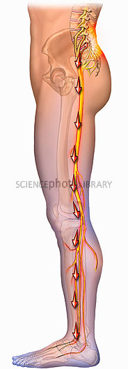 radiculopathy